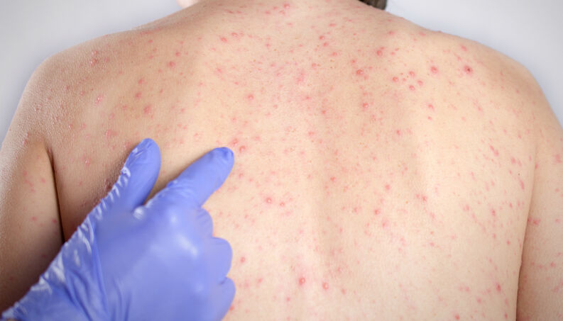 costas-sarampo-manchas-1400x800 costas-sarampo-manchas-1400x800