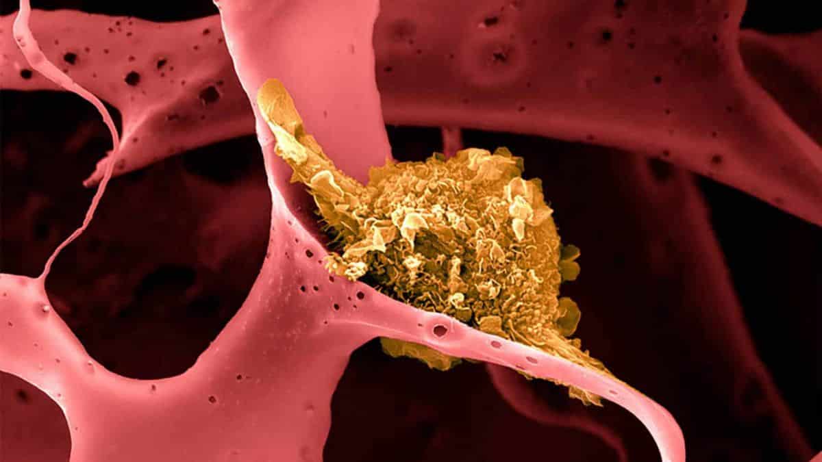 20201111045143_1200_675_-_celula_tumoral 20201111045143_1200_675_-_celula_tumoral