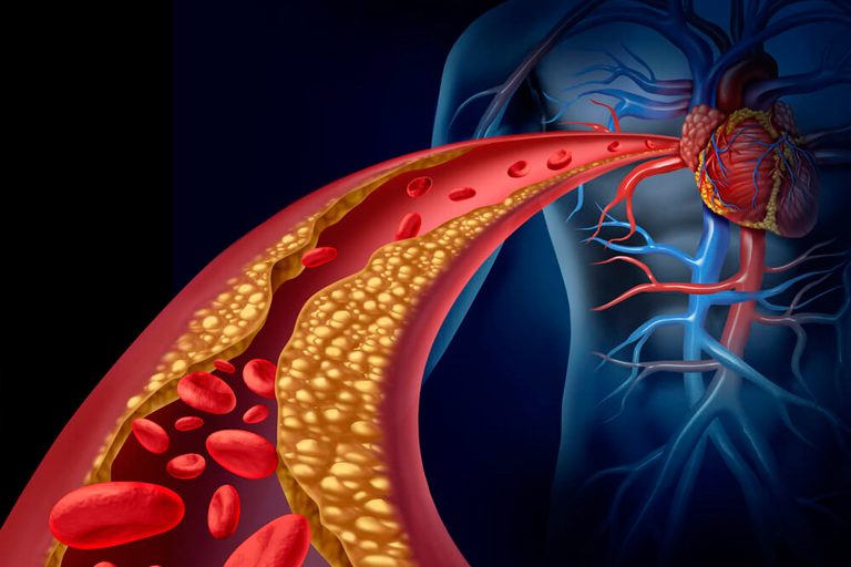 colesterol-alto-sintomas-e-o-que-deve-ser-feito-ao-identificar-768x512