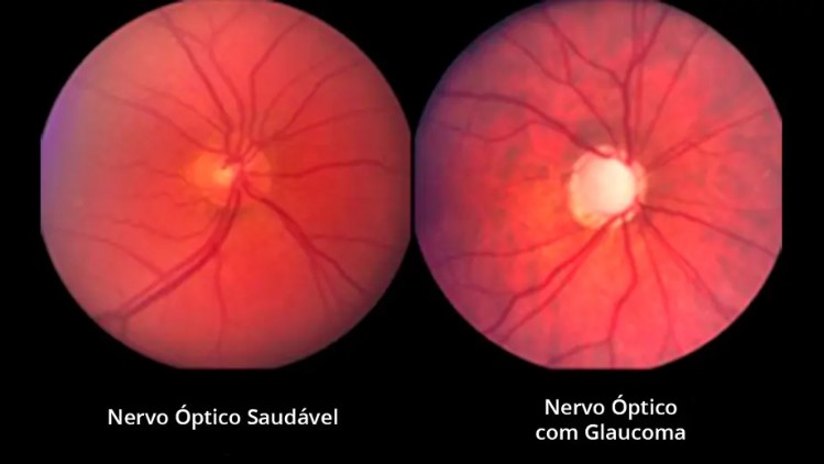 Glaucoma