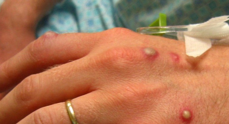 variola-macaco-monkeypox-20052022150612452 variola-macaco-monkeypox-20052022150612452