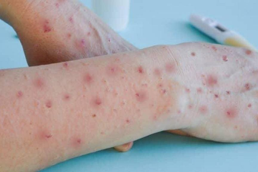 variola-5-1000fa70f3 variola-5-1000fa70f3