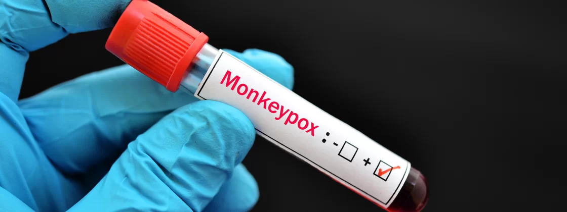 variola-macacos-1-2ac285d4db variola-macacos-1-2ac285d4db