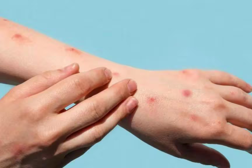 variola-macacos-5-9aa0307b13