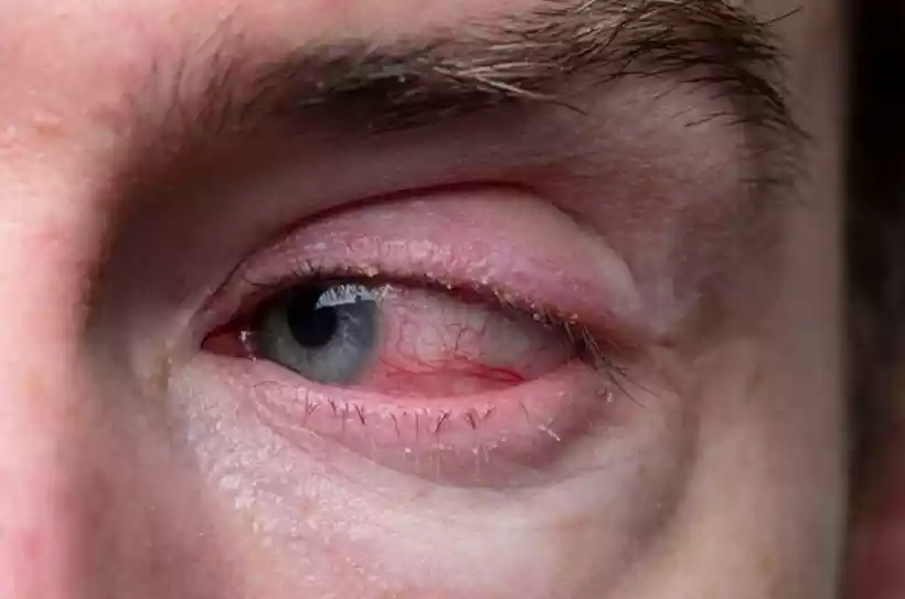 olho-vermelho-5-5e54482f5f olho-vermelho-5-5e54482f5f