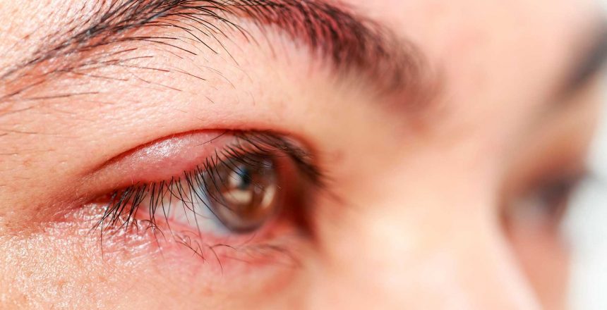 Saiba-o-que-causa-e-como-evitar-o-inchaço-das-pálpebras