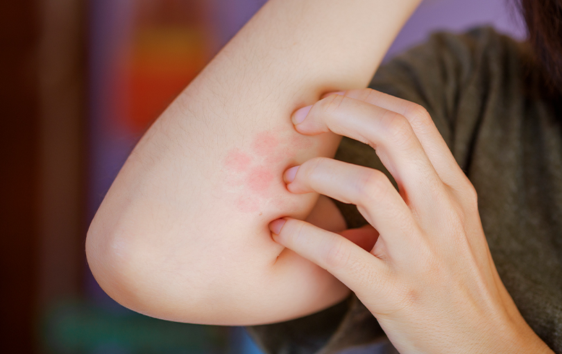 apareceu-uma-picada-de-inseto-desconhecido-aaiba-como-agir-nesse-caso apareceu-uma-picada-de-inseto-desconhecido-aaiba-como-agir-nesse-caso