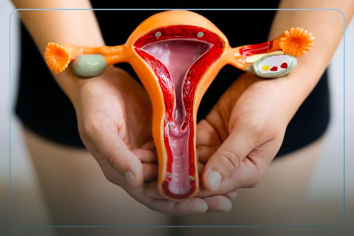 Endometriose-profunda Endometriose-profunda