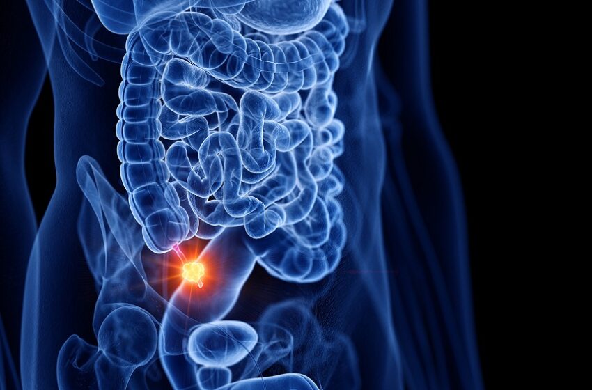 Cancer-de-apendice-1b-850x560