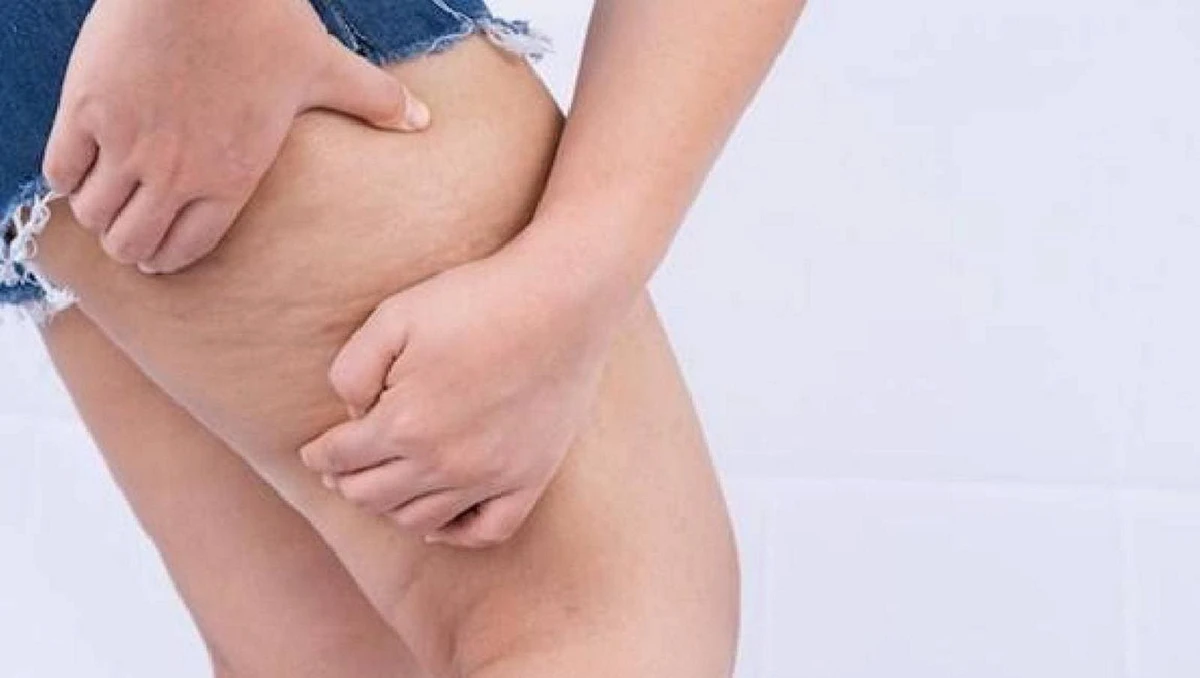 interessa-o-lipedema-1708272929 interessa-o-lipedema-1708272929