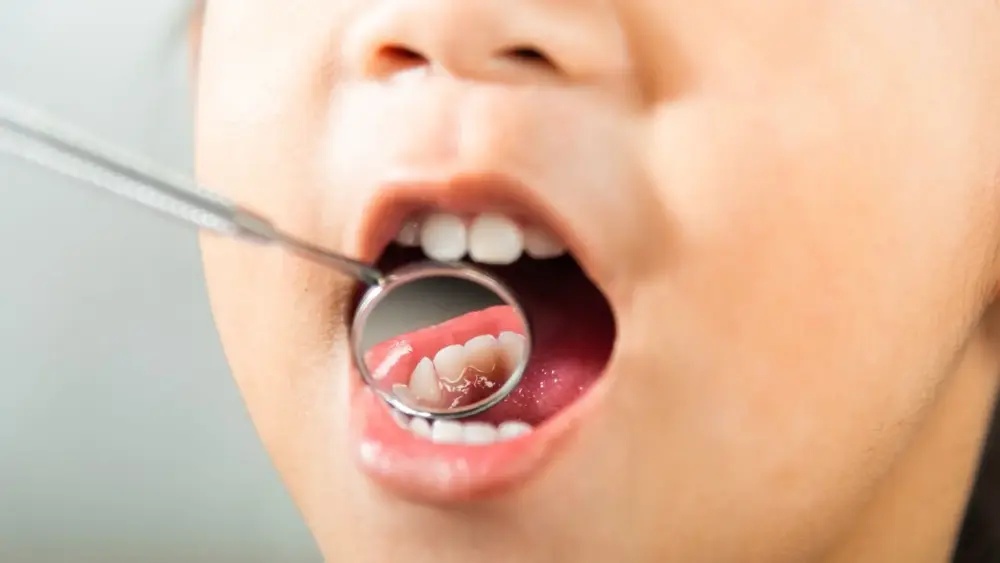 dente-crianca-4fc45eb27e4514 dente-crianca-4fc45eb27e4514