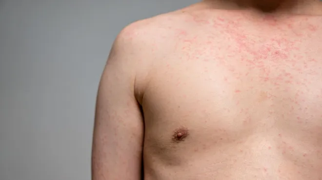 manchas-vermelhas-de3cf085b4-4049-43b4-ad4d-736f89fc0558