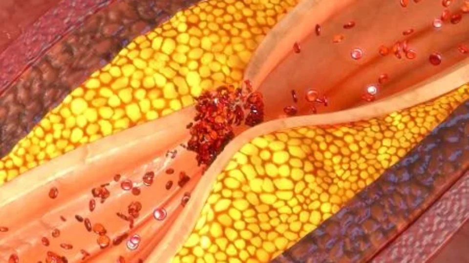 aterosclerose-1539525443575_v2_450x450-960x540