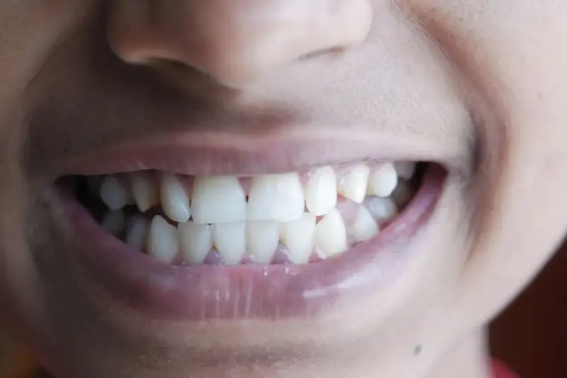 dentes-sorriso-bruxismo-8e4e8ef6717fcbe6